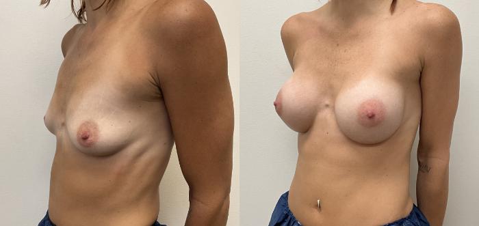 Before & After Breast Augmentation Case 415 Left Oblique View in Barrington, Illinois