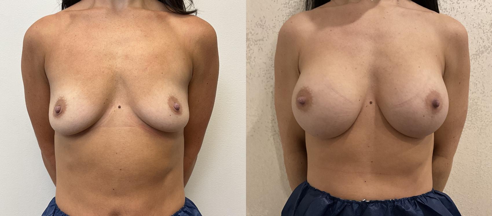 Before & After Breast Augmentation Case 416 Front View in Barrington, Illinois