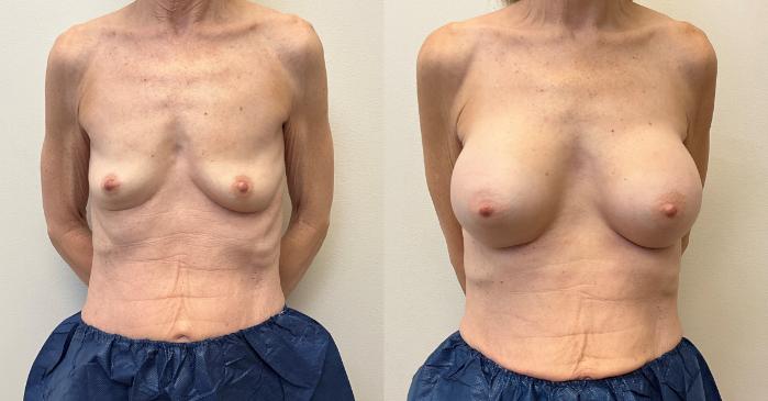 Before & After Breast Augmentation Case 427 Front View in Barrington, Illinois