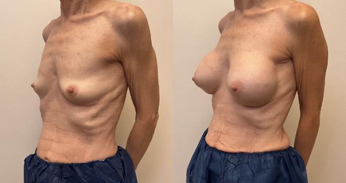 Before & After Breast Augmentation Case 427 Right Oblique View in Barrington, Illinois