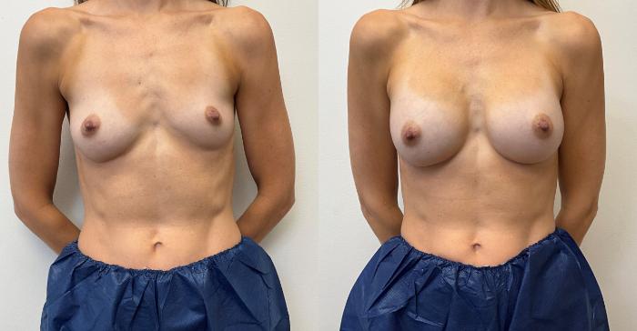 Before & After Breast Augmentation Case 432 Front View in Barrington, Illinois