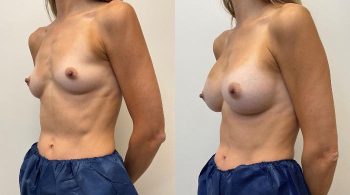 Before & After Breast Augmentation Case 432 Left Oblique View in Barrington, Illinois
