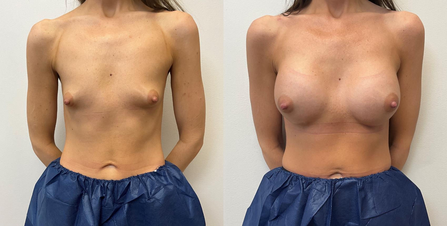 Before & After Breast Augmentation Case 433 Front View in Barrington, Illinois
