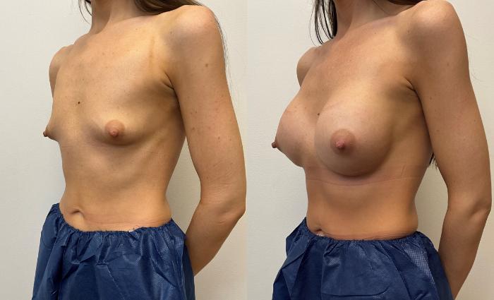 Before & After Breast Augmentation Case 433 Left Oblique View in Barrington, Illinois