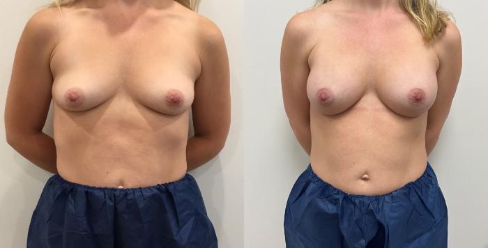 Before & After Breast Augmentation Case 434 Front View in Barrington, Illinois