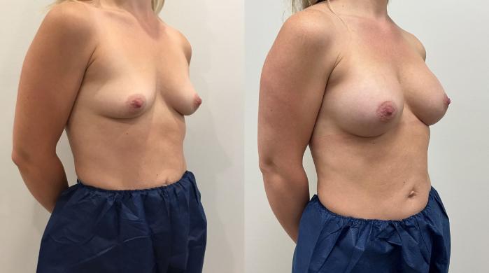 Before & After Breast Augmentation Case 434 Right Oblique View in Barrington, Illinois