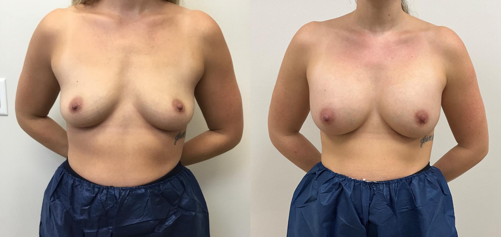 Before & After Breast Augmentation Case 435 Front View in Barrington, Illinois