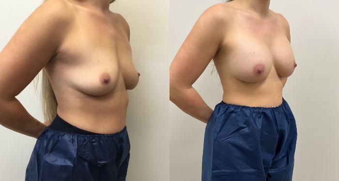 Before & After Breast Augmentation Case 435 Right Oblique View in Barrington, Illinois