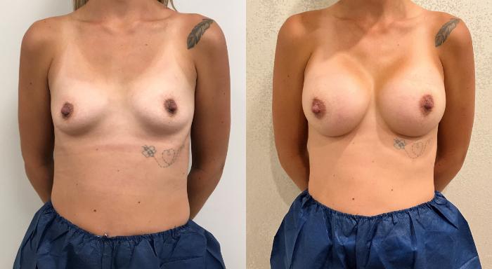 Before & After Breast Augmentation Case 436 Front View in Barrington, Illinois