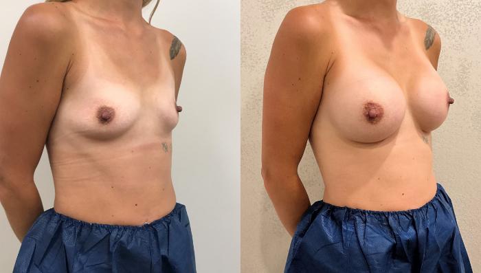 Before & After Breast Augmentation Case 436 Right Oblique View in Barrington, Illinois
