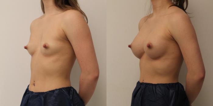 Before & After Breast Augmentation Case 53 View #2 View in Barrington, Illinois