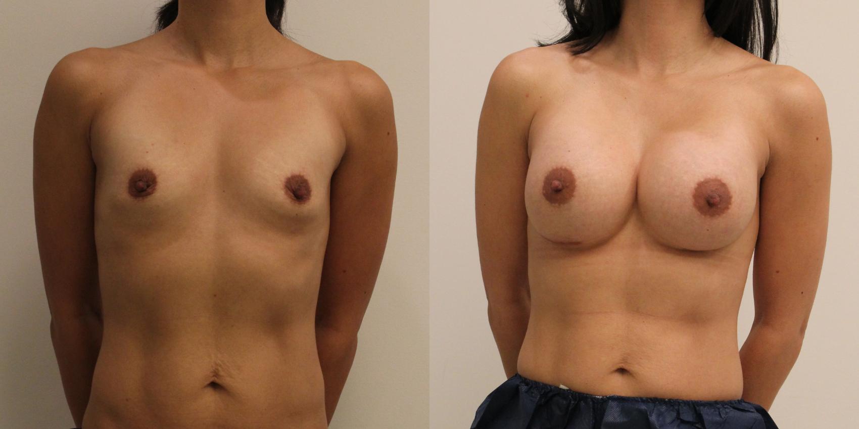 Before & After Breast Augmentation Case 56 View #1 View in Barrington, Illinois