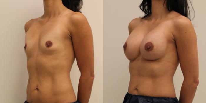 Before & After Breast Augmentation Case 56 View #2 View in Barrington, Illinois