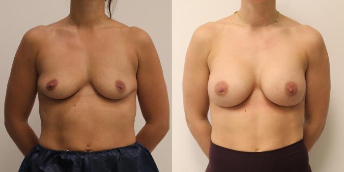 Before & After Breast Augmentation Case 59 View #1 View in Barrington, Illinois