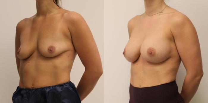 Before & After Breast Augmentation Case 59 View #2 View in Barrington, Illinois