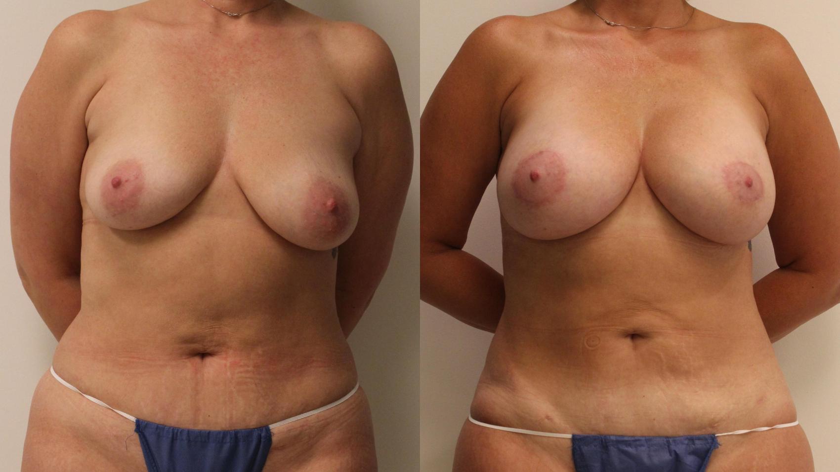 Before & After Breast Lift Case 73 Front View in Barrington, Illinois