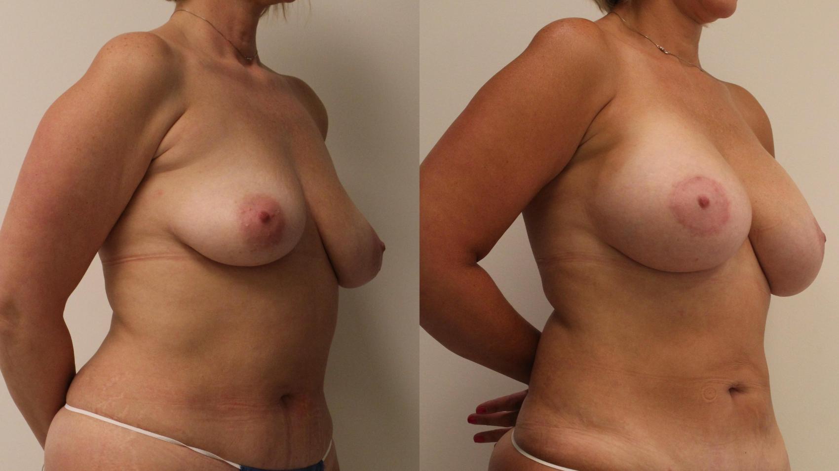 Before & After Breast Augmentation Case 73 Right Oblique View in Barrington, Illinois