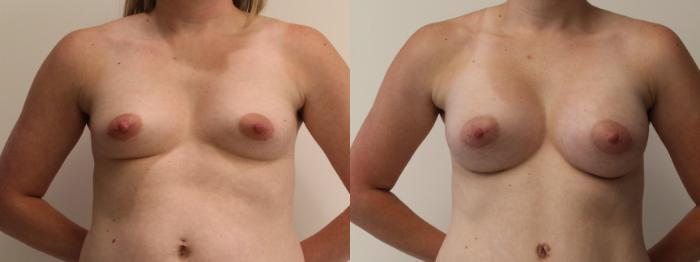Before & After Breast Augmentation Case 74 Front View in Barrington, Illinois