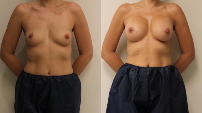 Before & After Breast Augmentation Case 87 Front View in Barrington, Illinois