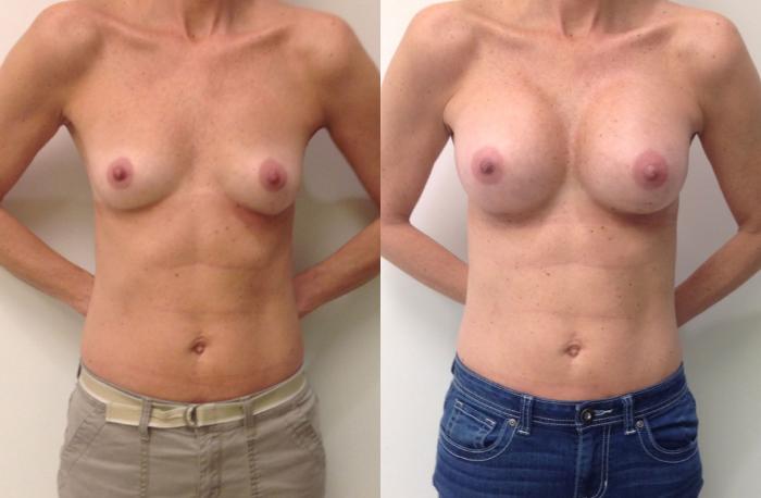 Before & After Breast Augmentation Case 9 View #1 View in Barrington, Illinois