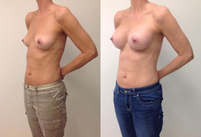 Before & After Breast Augmentation Case 9 View #2 View in Barrington, Illinois
