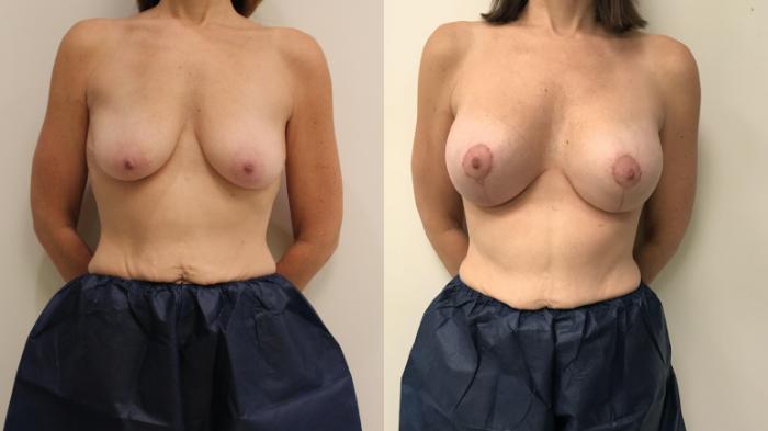 Before & After Breast Lift Case 93 Front View in Barrington, Illinois