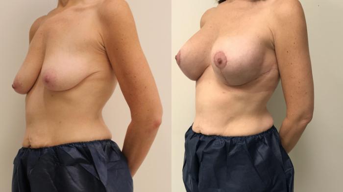 Before & After Breast Lift Case 93 Left Oblique View in Barrington, Illinois