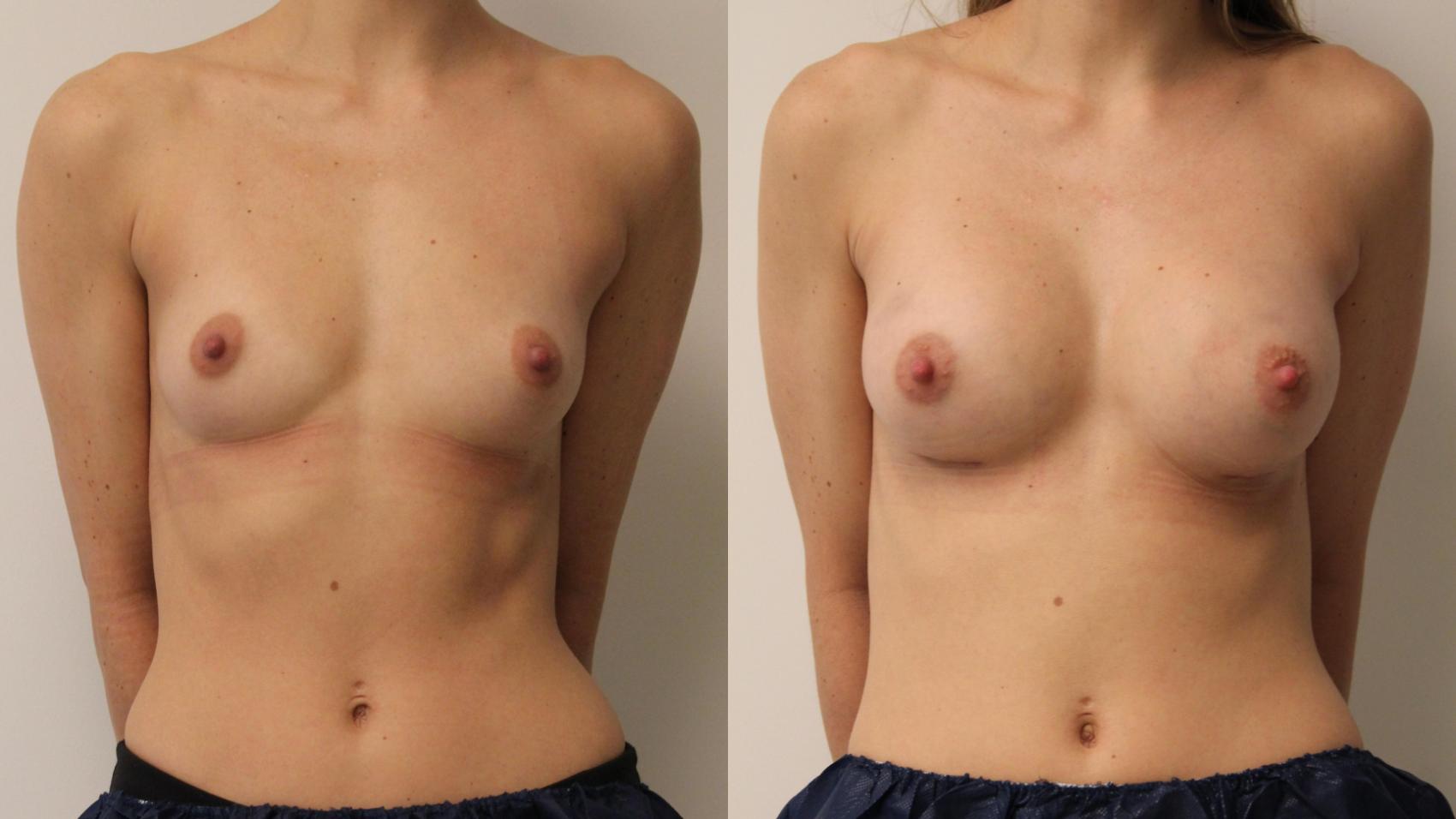 Before & After Breast Augmentation Case 95 Front View in Barrington, Illinois