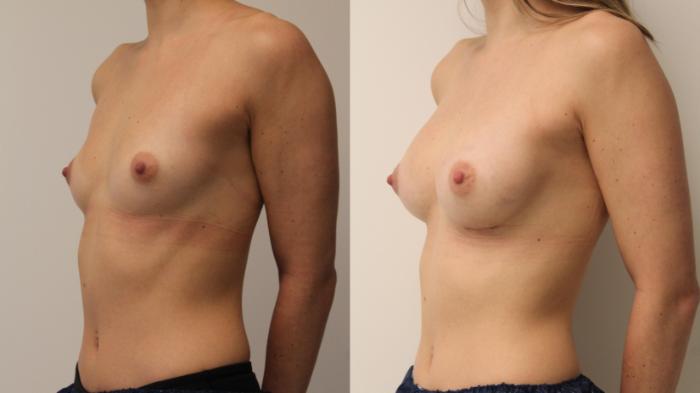 Before & After Breast Augmentation Case 95 Left Oblique View in Barrington, Illinois