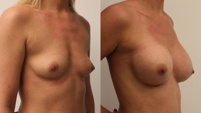 Before & After Breast Augmentation Case 97 Right Oblique View in Barrington, Illinois