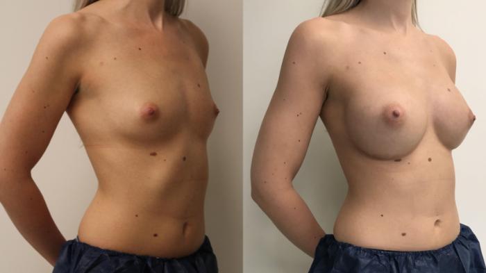 Before & After Breast Augmentation Case 99 Right Oblique View in Barrington, Illinois