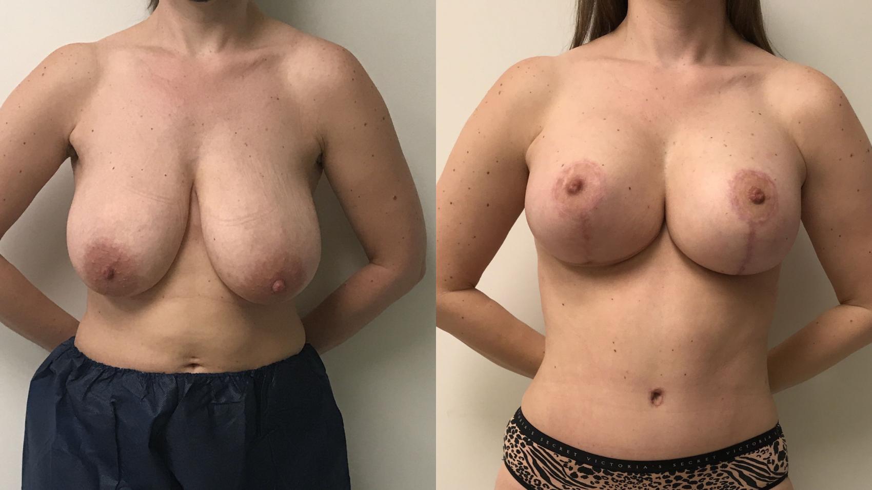 Before & After Breast Augmentation with Mastopexy (Lift) Case 174 Front View in Barrington, Illinois