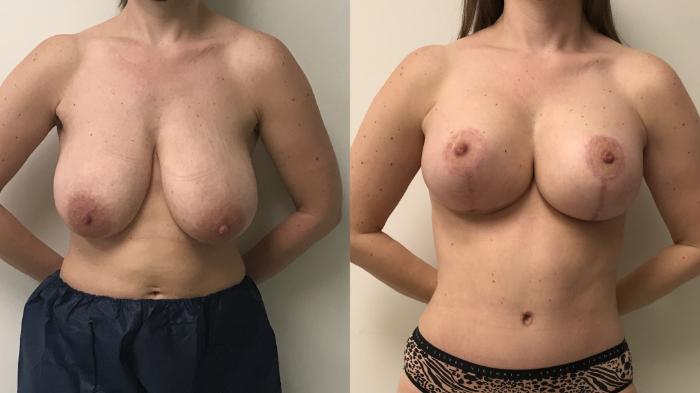 Before & After Breast Augmentation Case 174 Front View in Barrington, Illinois