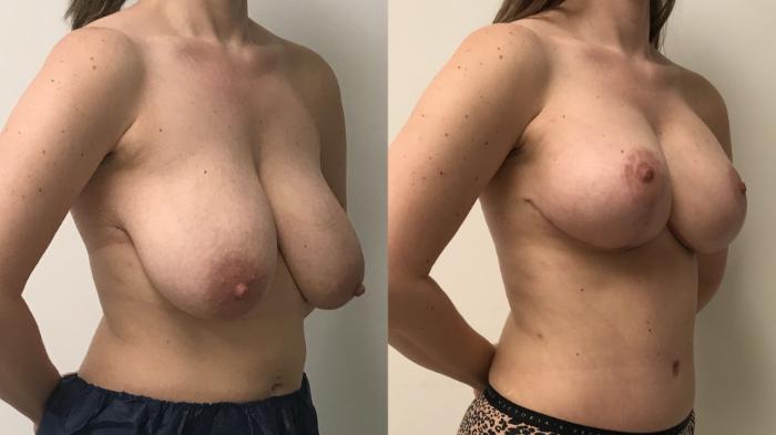 Before & After Breast Augmentation with Mastopexy (Lift) Case 174 Right Oblique View in Barrington, Illinois