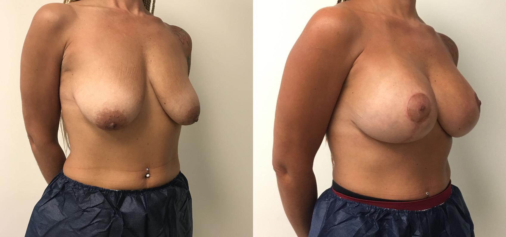 Before & After Breast Lift Case 201 Right Oblique View in Barrington, Illinois