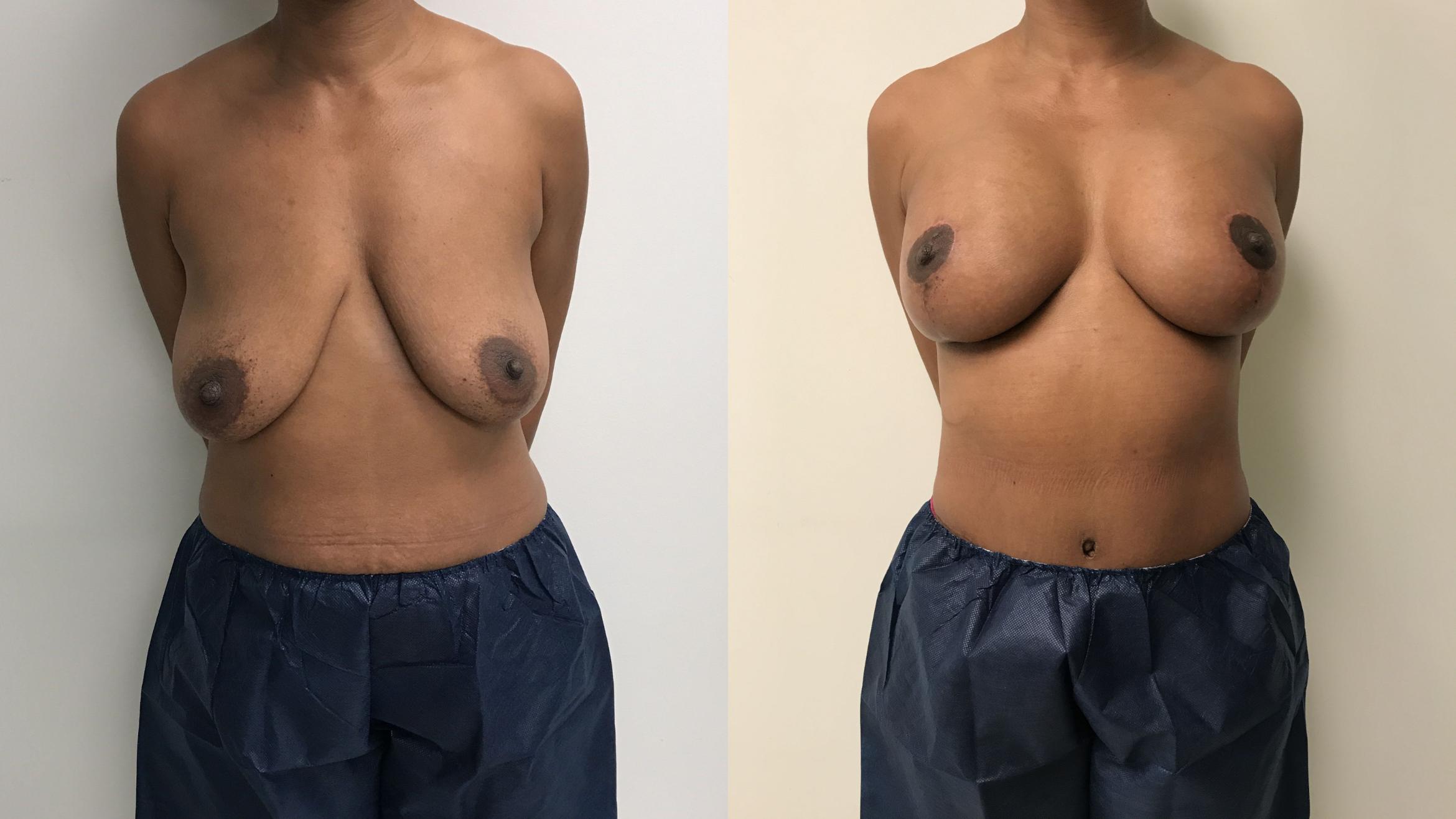 Before & After Breast Augmentation with Mastopexy (Lift) Case 213 Front View in Barrington, Illinois