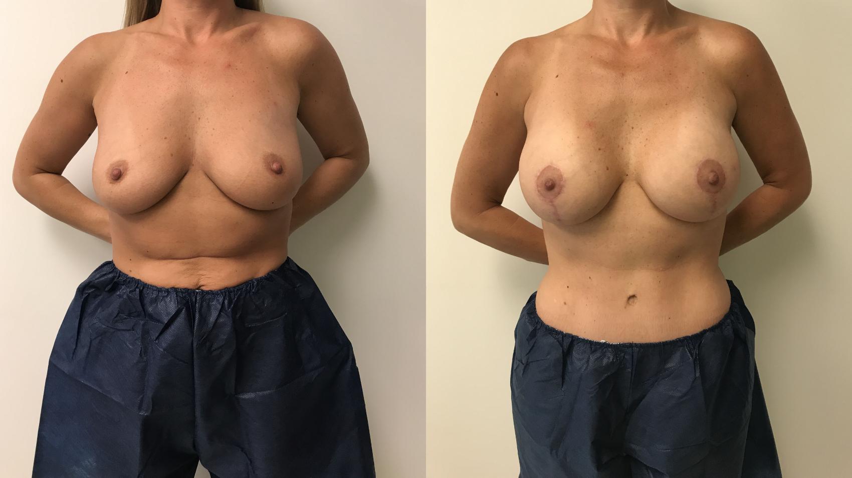 Before & After Breast Lift Case 230 Left Oblique View in Barrington, Illinois
