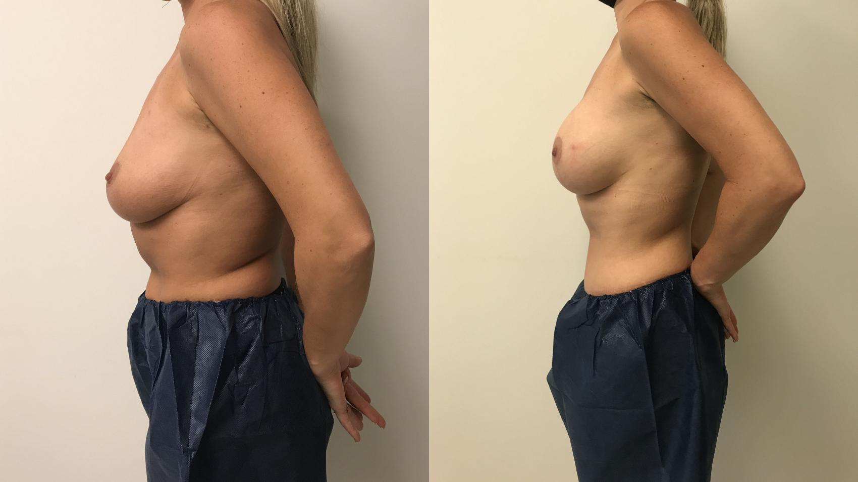 Before & After Breast Augmentation with Mastopexy (Lift) Case 230 Left Side View in Barrington, Illinois