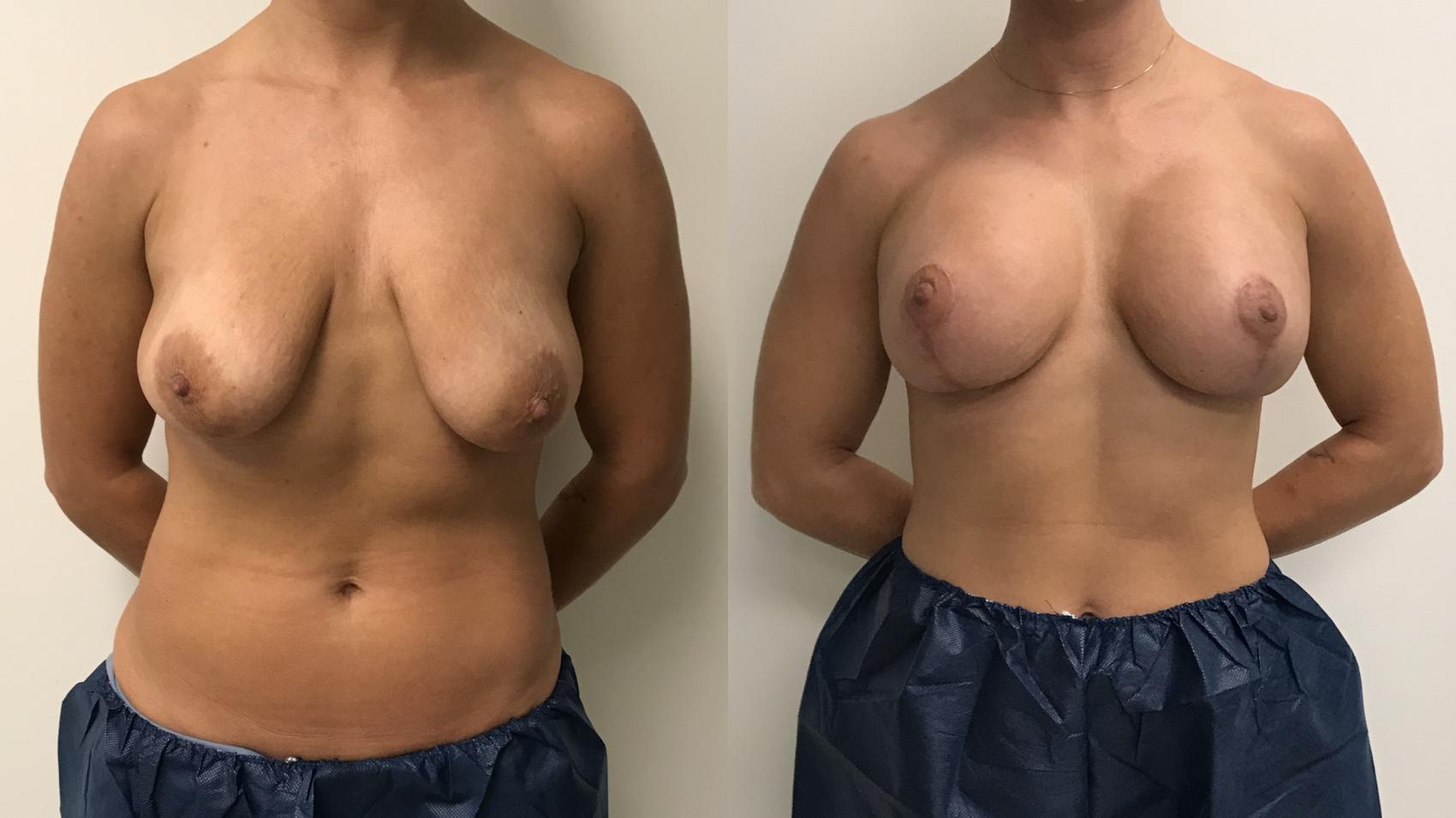 Before & After Breast Augmentation with Mastopexy (Lift) Case 307 Front View in Barrington, Illinois