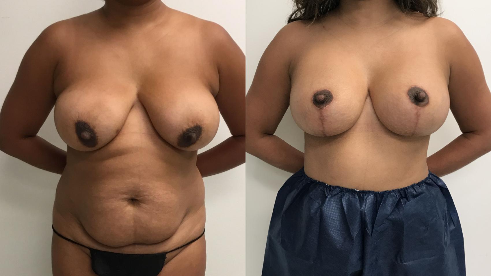 Before & After Breast Augmentation with Mastopexy (Lift) Case 315 Front View in Barrington, Illinois