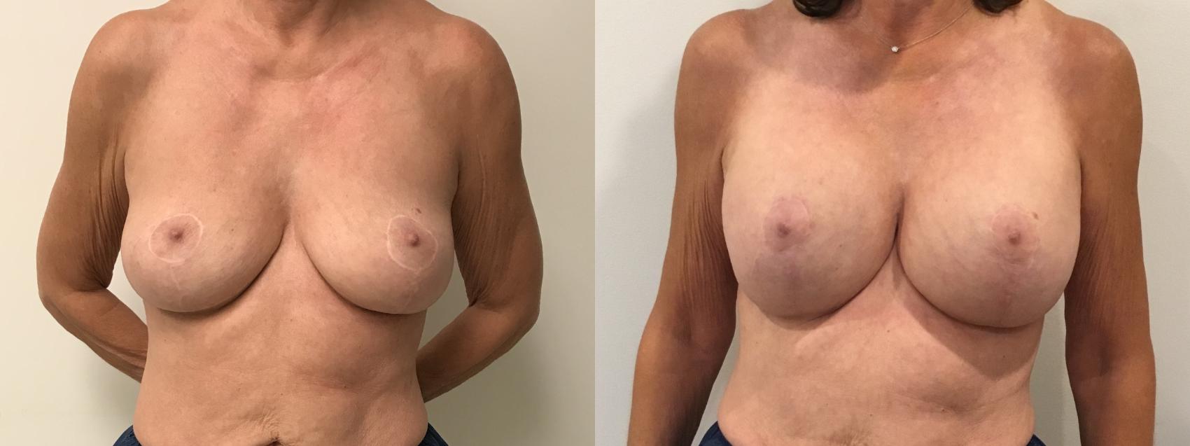 Before & After Breast Augmentation with Mastopexy (Lift) Case 317 Front View in Barrington, Illinois
