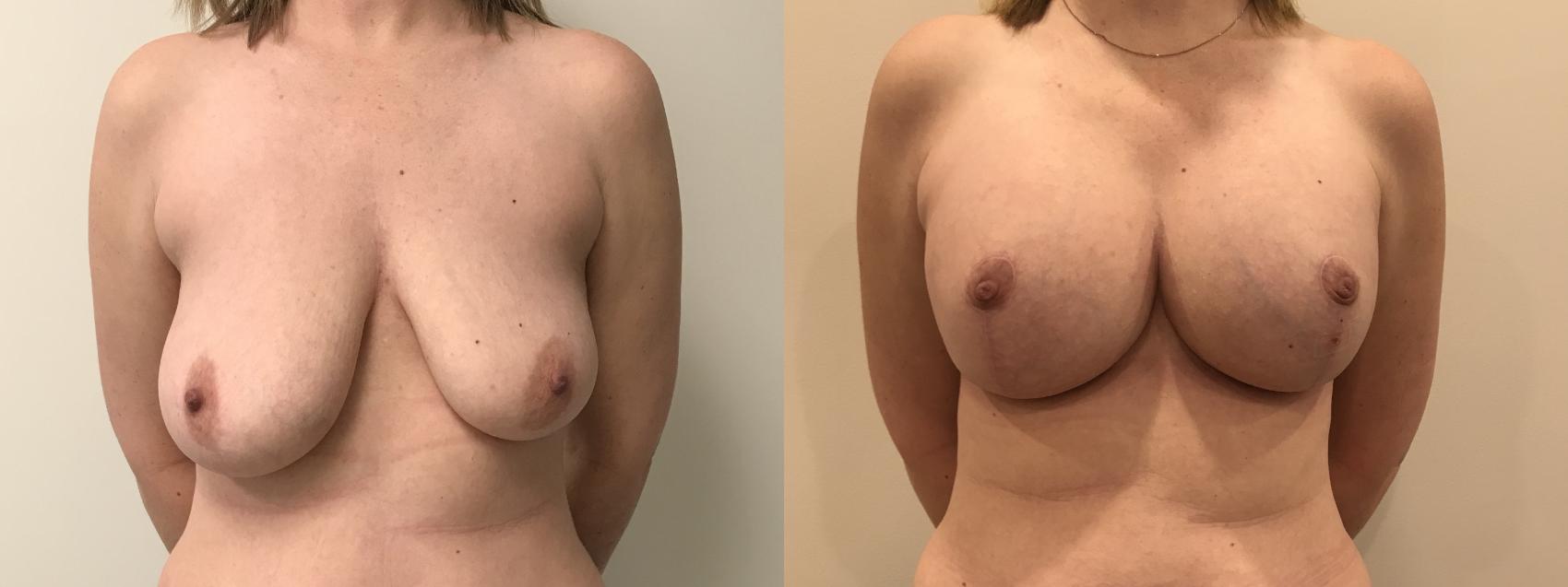 Before & After Breast Augmentation with Mastopexy (Lift) Case 319 Front View in Barrington, Illinois