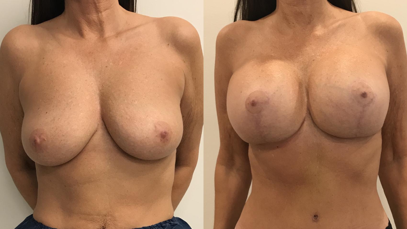 Before & After Breast Augmentation with Mastopexy (Lift) Case 322 Front View in Barrington, Illinois
