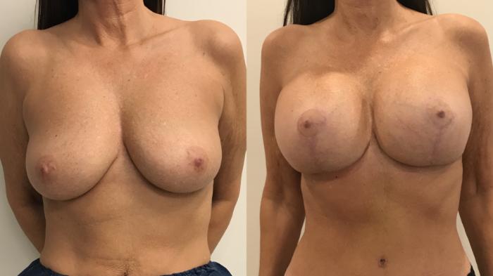 Before & After Breast Augmentation with Mastopexy (Lift) Case 322 Front View in Barrington, Illinois