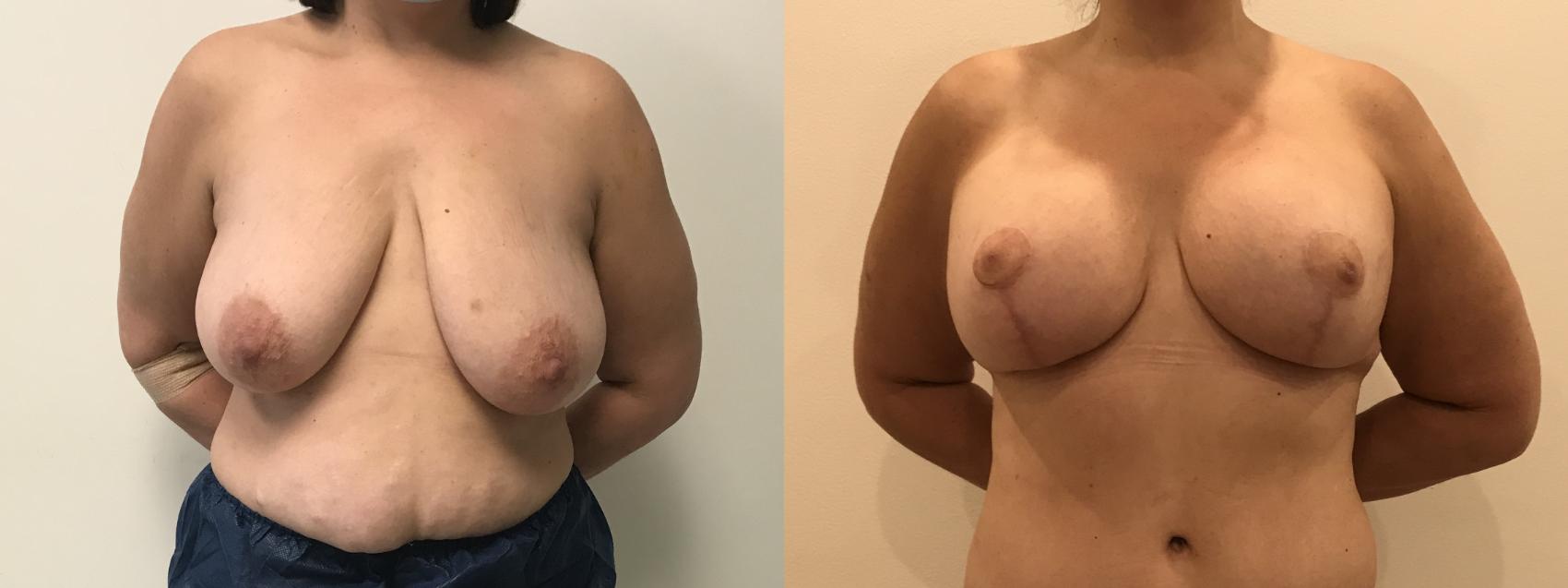 Before & After Breast Augmentation with Mastopexy (Lift) Case 323 Front View in Barrington, Illinois