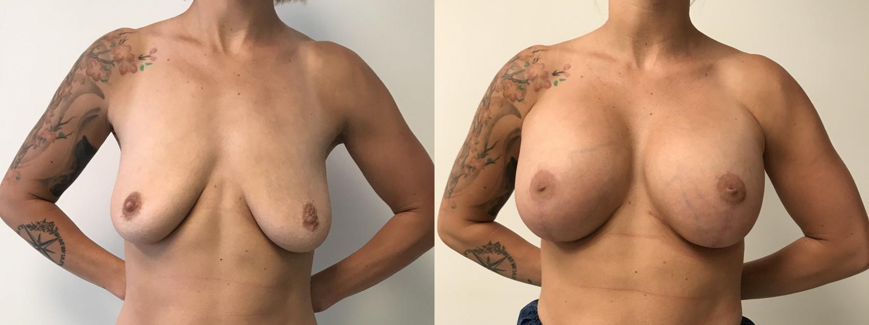 Before & After Breast Augmentation with Mastopexy (Lift) Case 351 Front View in Barrington, Illinois