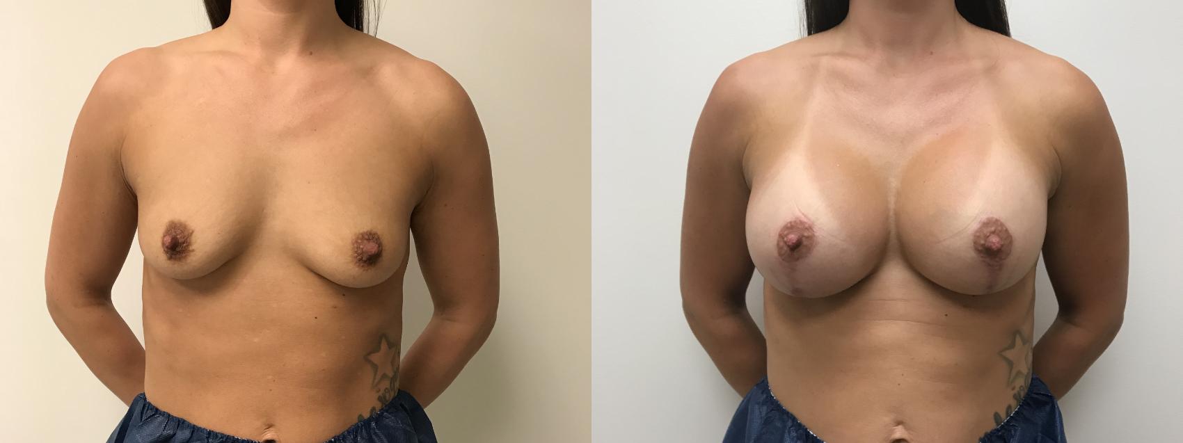 Before & After Breast Augmentation with Mastopexy (Lift) Case 353 Front View in Barrington, Illinois