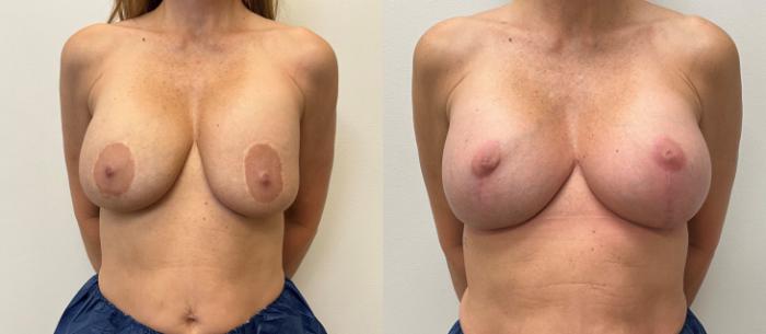 Before & After Breast Augmentation with Mastopexy (Lift) Case 367 Front View in Barrington, Illinois