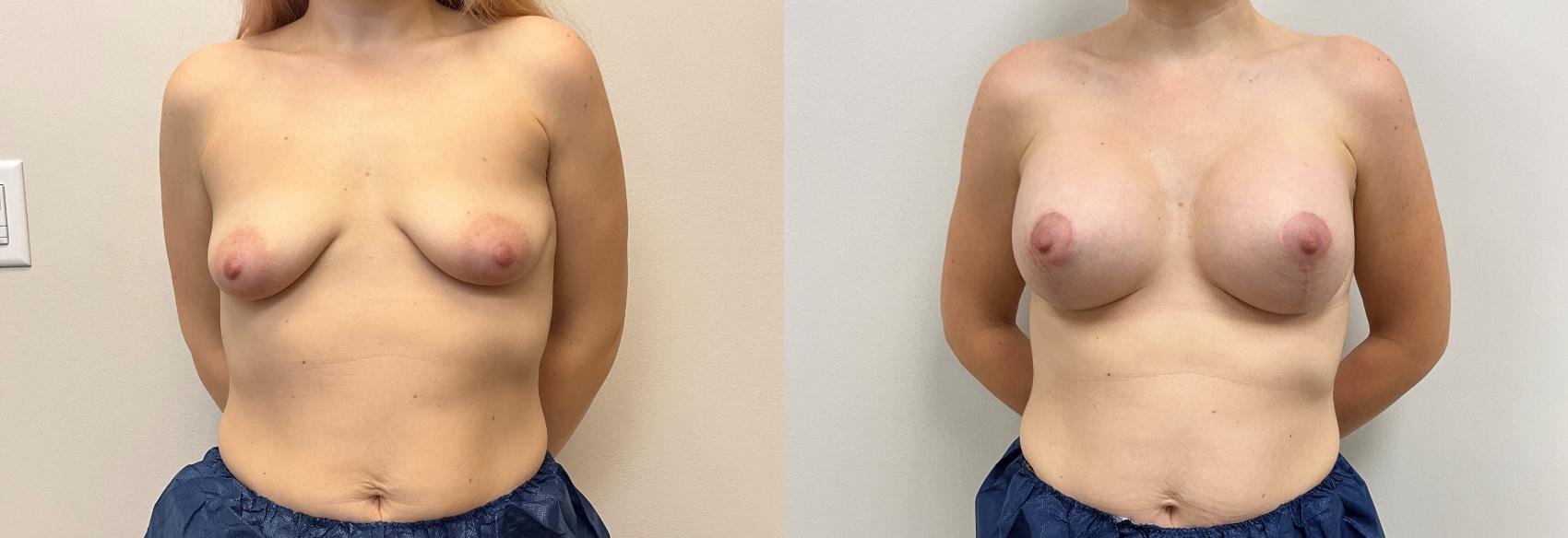 Before & After Breast Augmentation with Mastopexy (Lift) Case 368 Front View in Barrington, Illinois