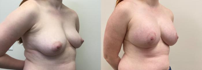 Before & After Breast Augmentation with Mastopexy (Lift) Case 370 Right Oblique View in Barrington, Illinois
